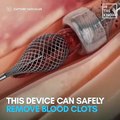 Safely Remove Blood Clots