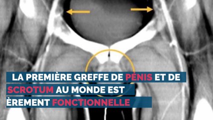La première greffe de pénis et de scrotum au monde est entièrement fonctionnelle