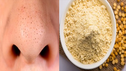 How To remove Black Heads Overnight | रात भर में गायब हो जाएंगे जिद्दी ब्लैकहेड्स | Boldsky