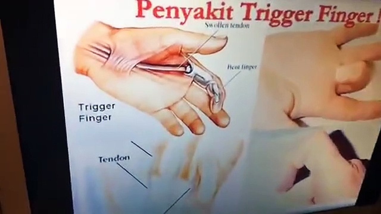 Arthritis, Gout, Sakit sa Kamay at Katawan, Tamang Paglakad - ni Doc Willie at Liza Ong