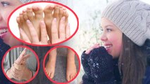 सर्दियों में उंगलियों की सूजन दूर करेंगे ये घरेलू उपाय | Finger Swelling remedies in Winter |Boldsky