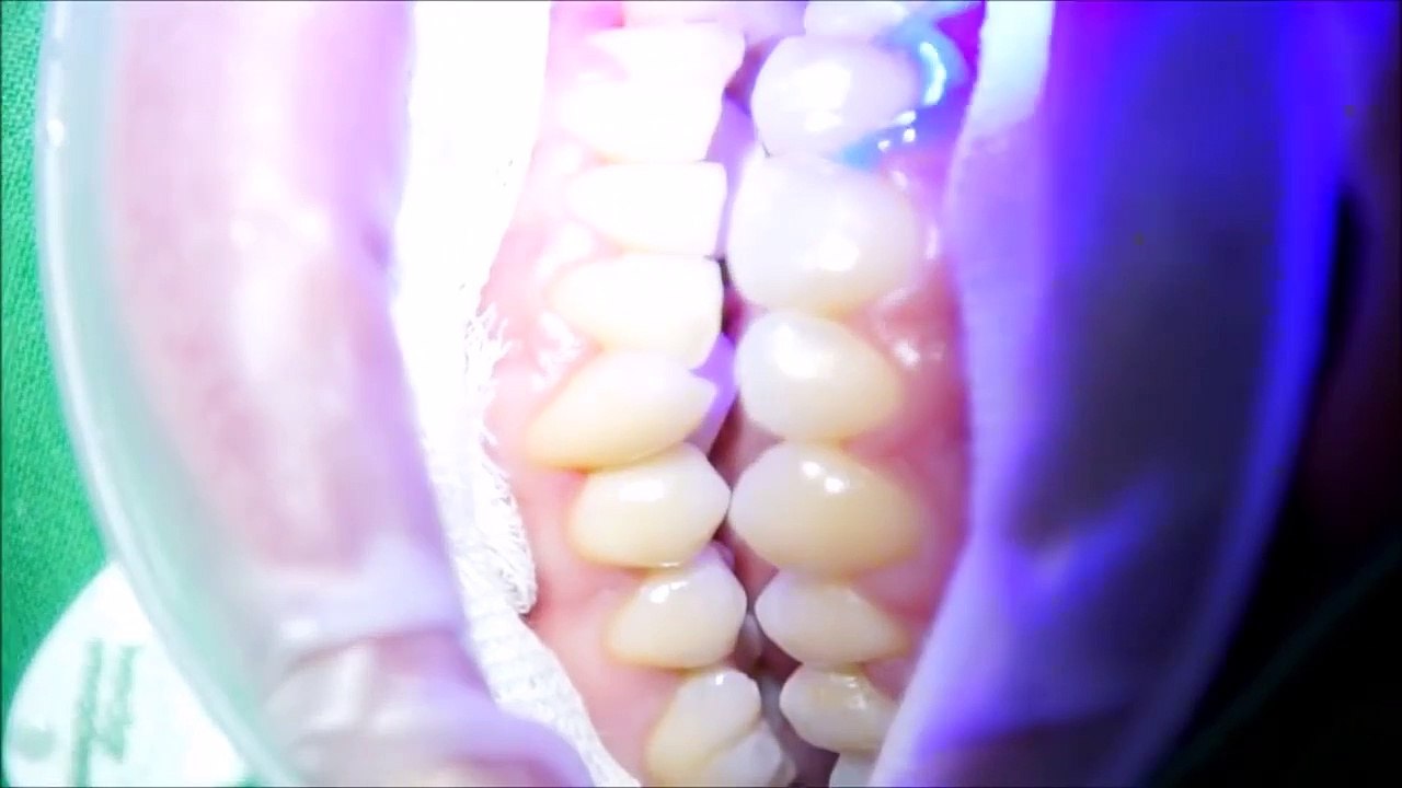 How to get a your teeth white through a laser? Check this for more!