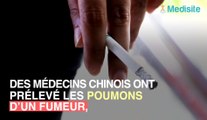 Des médecins révèlent les vraies images des poumons d'un fumeur