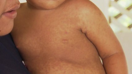 "사모아서 홍역으로 어린이 15명 포함 16명 사망" / YTN