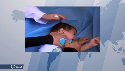 انتشار الإصابة بالليشمانيا  بشكل غير مسبوق في دير الزور