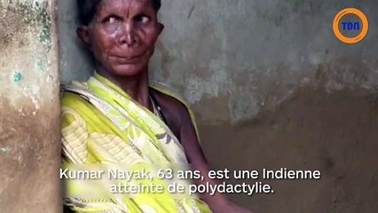 12 doigts et 20 orteils  : ses voisins ont peur d'elle