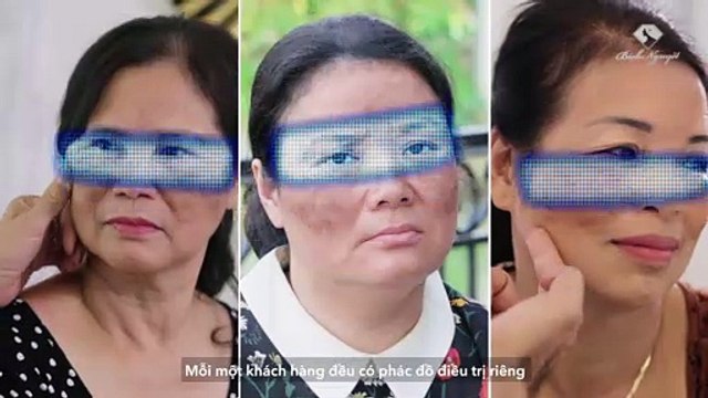 Phác Đồ Trị Nám Melas Ruby I Thẩm Mỹ Viện Bích Nguyệt