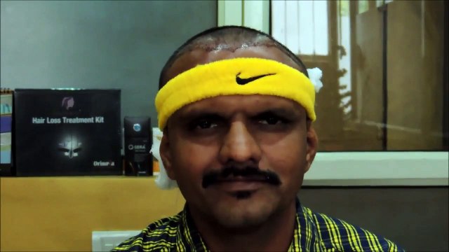 Sai Cosmetics Once Again Proved and Became my Go-To for FUE Hair Transplant in Pune – Patient