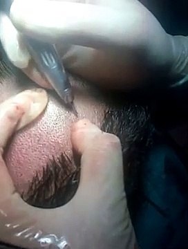 Live FUE Hair Transplant in Pune by Dr. Amitabh Shrivastava at Sai Cosmetics