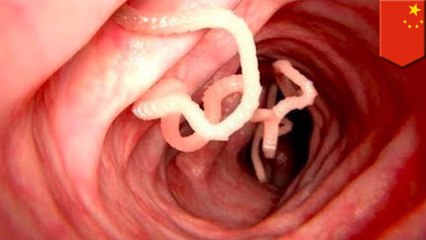 Man has over 700 tapeworms from eating undercooked meat in China