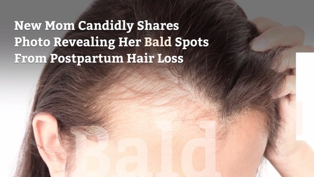 New Mom Candidly Shares Photo Revealing Her Bald Spots From Postpartum Hair Loss