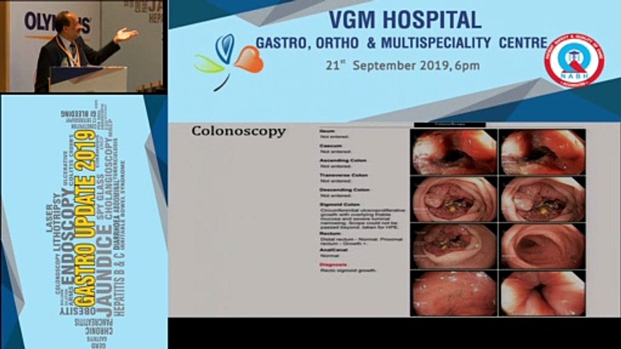 Dr.V.G.Mohan Prasad explains about Lower GastroIntestinal Bleeding (LGIB) Procedures and Treatment - Gastro Update 2019