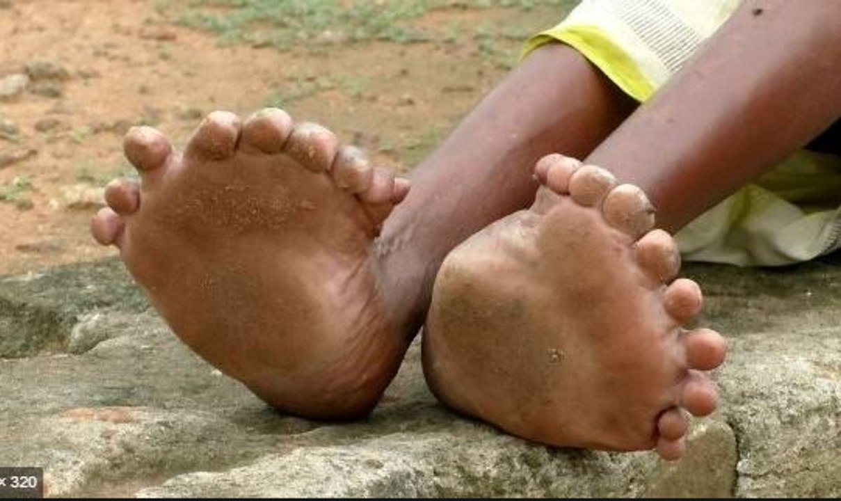 This Odisha woman has 20 toes and 12 fingers | OneIndia News