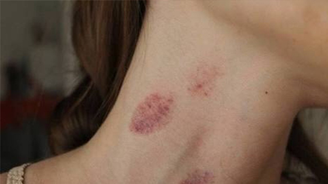  How To Give Love Bites Love Bites