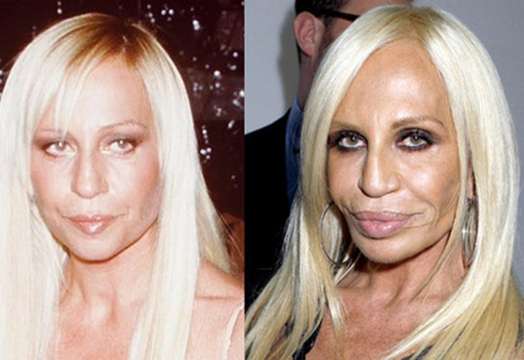 Cirugía estética: Las peores operaciónes plásticas de las famosas