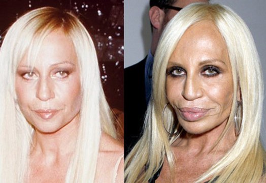 Cirugía estética: Las peores operaciónes plásticas de las famosas