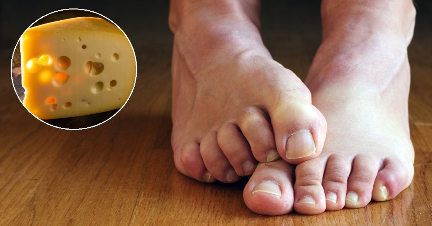 Pourquoi vos pieds sentent-ils le fromage ?