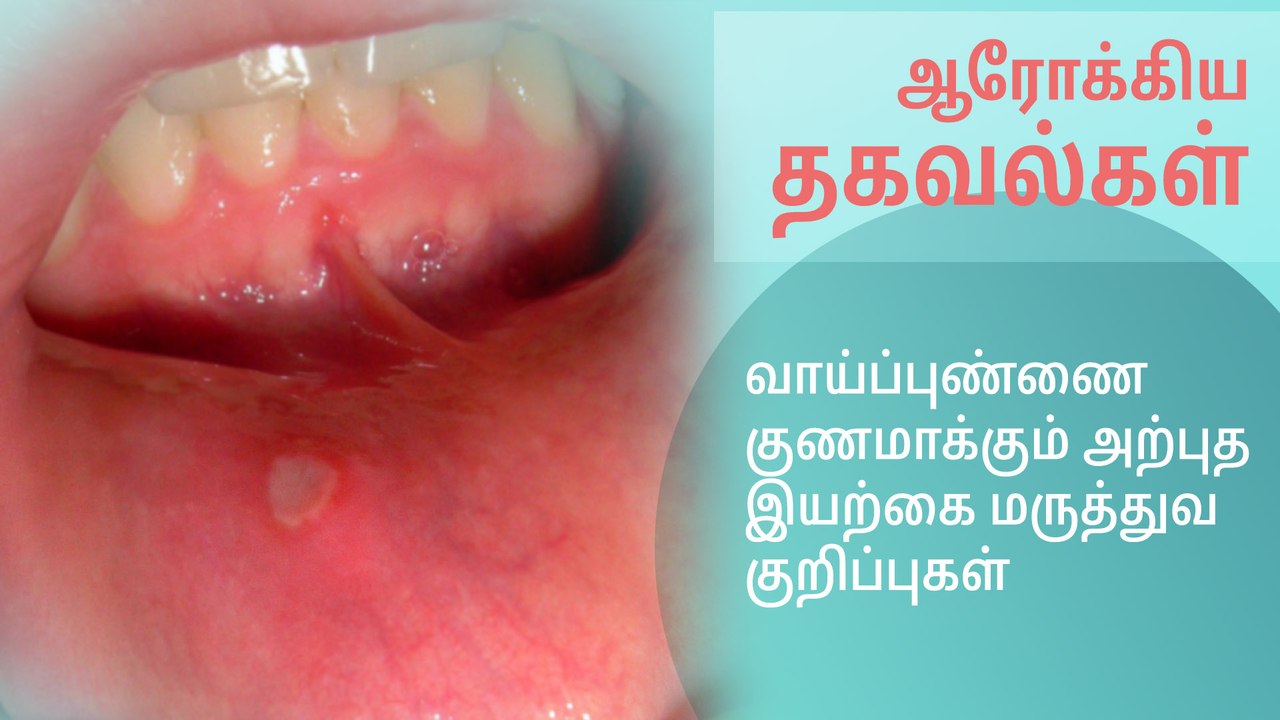 வாய்ப்புண்ணை குணமாக்கும் அற்புத இயற்கை மருத்துவ குறிப்புகள்..!