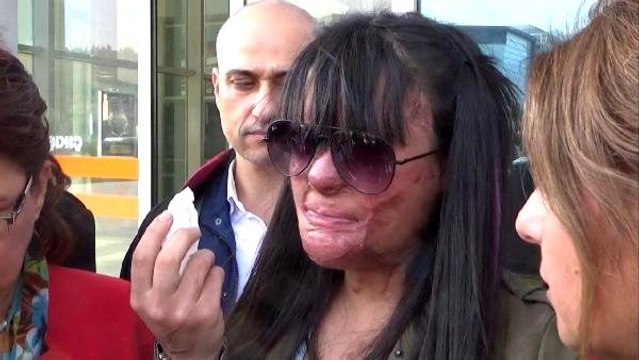 Yüzüne asit atılan Berfin: Kadına şiddet son bulsun