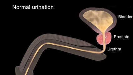 bd-cancer-de-prostata-261119