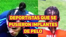 Deportistas que se pusieron implantes de pelo