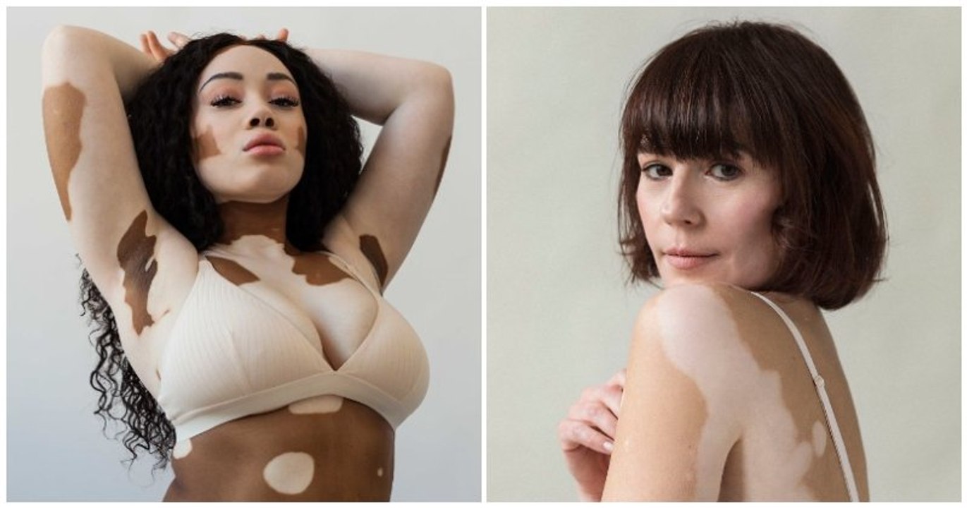 Une séance photo en « ode à la beauté et à l'unicité » du vitiligo prise par une photographe elle-même atteinte