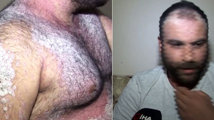 Sedef Hastalığı Yüzünden Dışarı Çıkamıyor