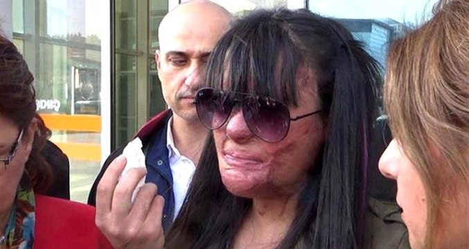 Asitli saldırıya uğrayan Berfin Özek: Çektiğim acılar 1-2 yıla sığacak acılar değil