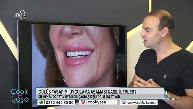 Gülüş tasarımı aşamaları nelerdir? Nasıl yapılır?