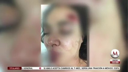 Hija de Abril Pérez muestra heridas hechas a su mamá