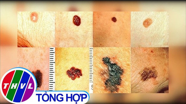 Tia cực tím, ô nhiễm gia tăng kéo theo ung thư da