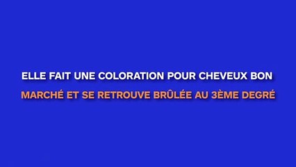 Elle utilise une coloration pour cheveux bon marché et se retrouve avec le cuir chevelu brûlé au troisième degré