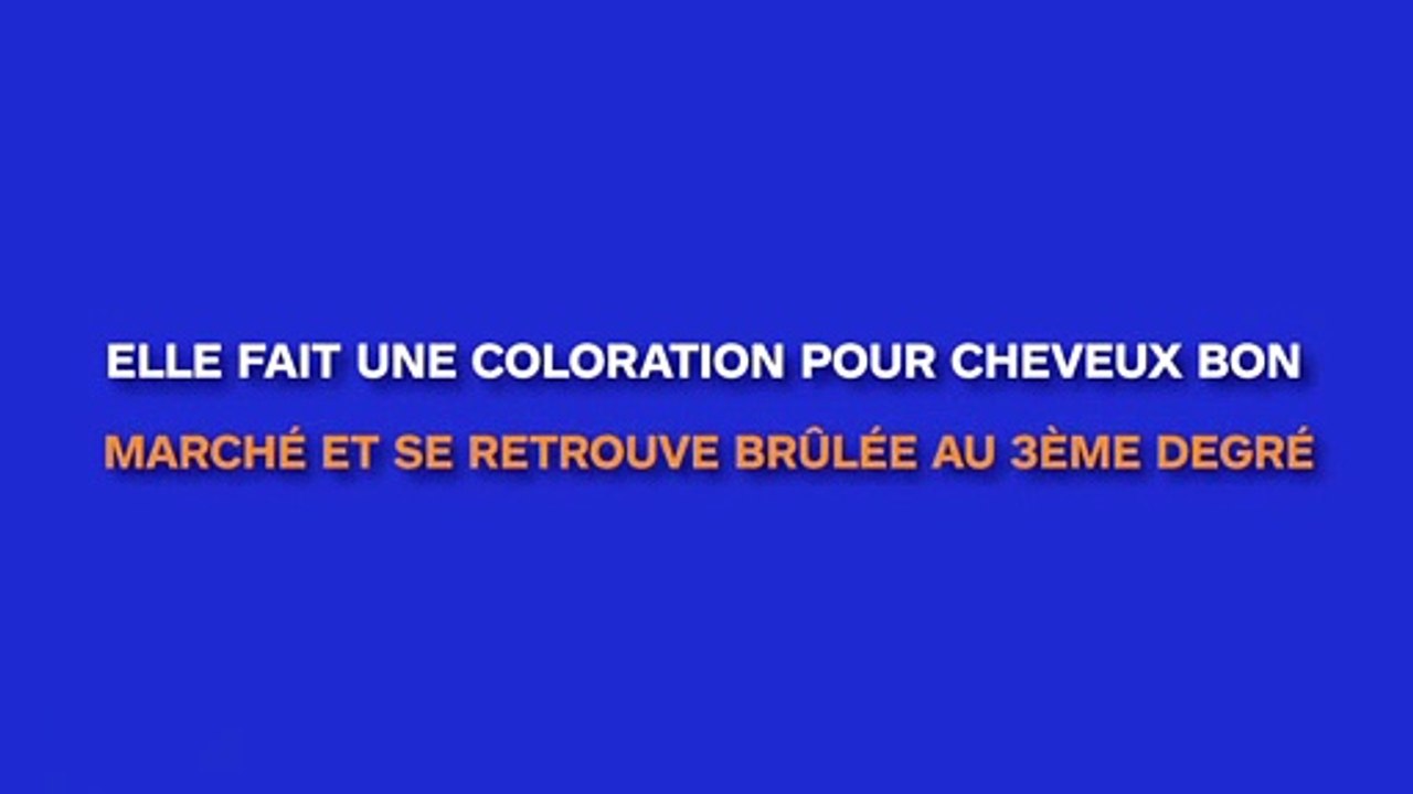 Elle utilise une coloration pour cheveux bon marché et se retrouve avec le cuir chevelu brûlé au troisième degré