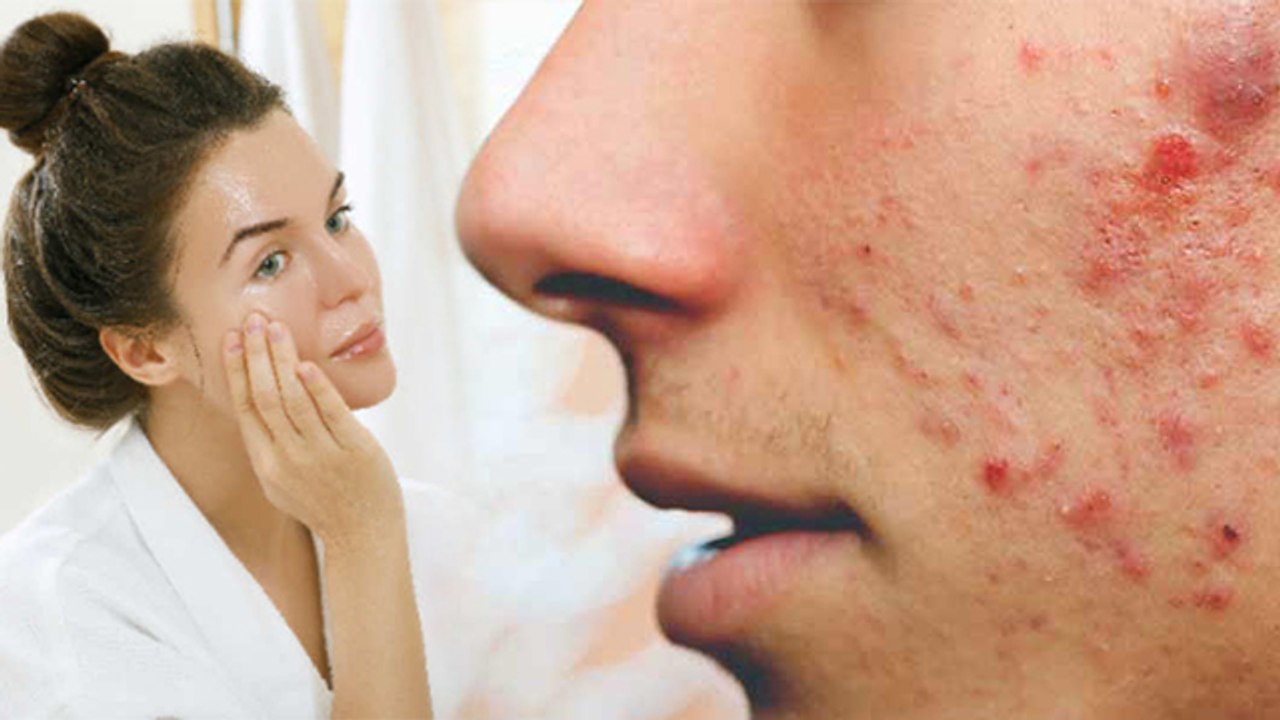 How To Remove DARK SPOTS, BLACK SPOTS & ACNE SCARS | Home Remedies | Boldsky