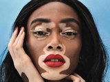 Atteinte de vitiligo, elle devient top model malgré les réactions des gens