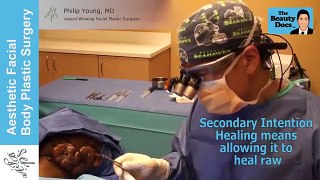 JAW, CHEEK, FACE KELOID LIVE SURGICAL REMOVAL BY DR PHILIP YOUNG BELLEVUE SEATTLE