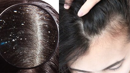 गंजेपन से लेकर डैंड्रफ में राहत दिलाएगी काली मिर्च | Is Black Pepper Good for your Hair | Boldsky