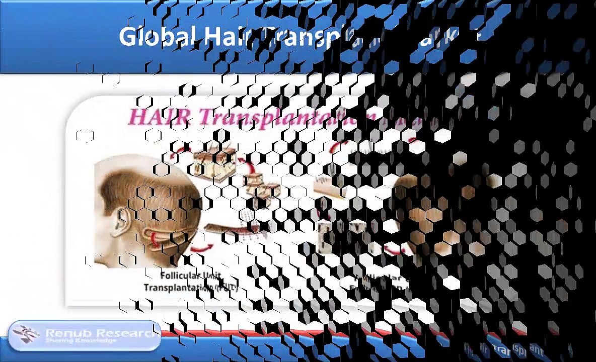 Global Hair Transplant Market is US$ 30 Billion by 2025 - Renub Research