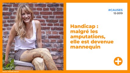 Handicap : malgré les amputations, elle est devenue mannequin