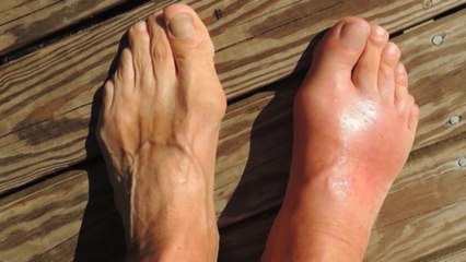 bd-hablamos-sobre-acido-urico-181219