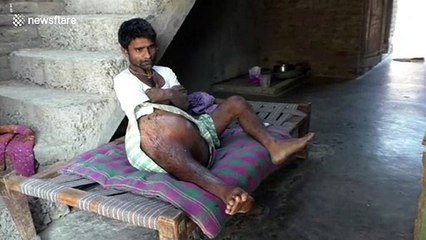 Man with massive swelling in thigh seeks help to get his cancerous limb amputated in western India