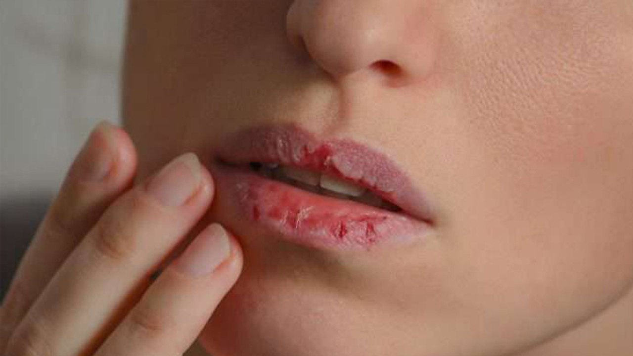 फटे होठों को सिर्फ 1 दिन में मुलायम बना देंगे ये घरेलू नुस्खे|How to get rid of Chapped Lips|Boldsky