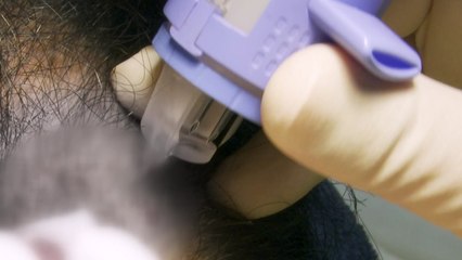 모발 이식 쉽고 빠르게...'연발형 이식기' 첫 상용화 / YTN