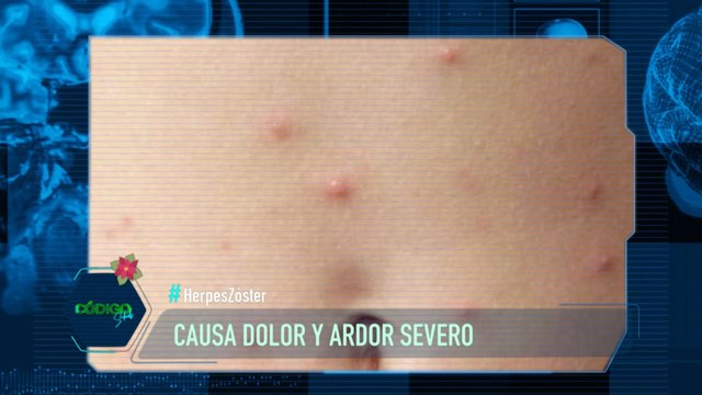 ¿Qué es y cómo se trata el herpes zóster?