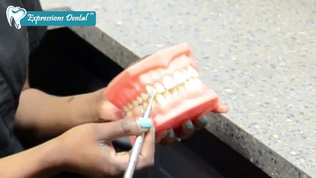 Learn The Benefits Of Dental Scaling With Our Dental Hygienist In Calgary