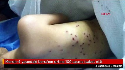 Mersin-4 yaşındaki berra'nın sırtına 100 saçma isabet etti