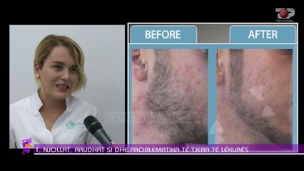 Ftesë në 5, Vip Line: Lazeri Harmony XL Pro që bën mrekulli në fytyrë, 23 Dhjetor 2019, Pjesa 3