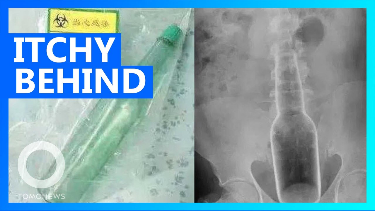 Man jams 18-cm long bottle into his behind to scratch an itch