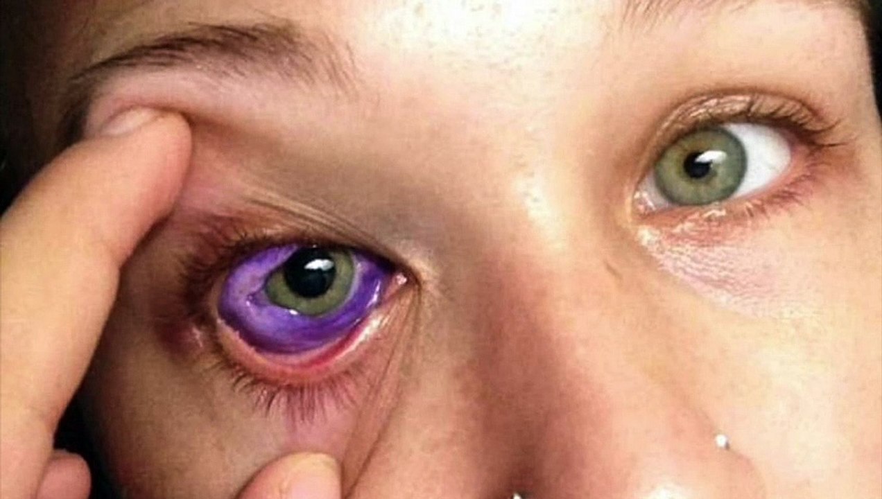 Elle a décidé de se faire tatouer l'oeil... Mais elle va le regretter toute sa vie !