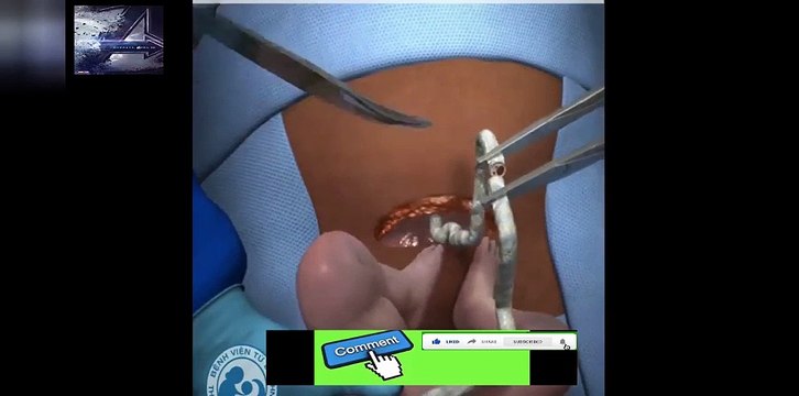 Mổ lấy thai là thế này đây các mẹ ơi Xem cho bớt run nhé Yên tâm ...